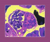 chloroquine for malaria image healthtips images